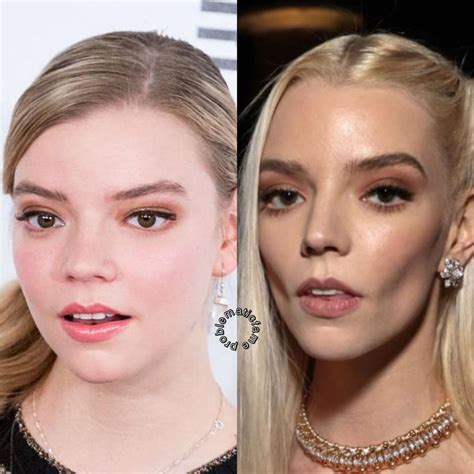 Anya Taylor Joy teeth then and now: before and after surgery。